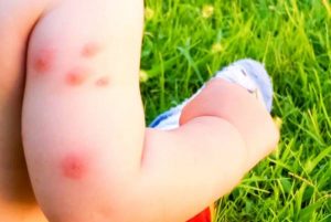 Common Baby Skin problems in infants