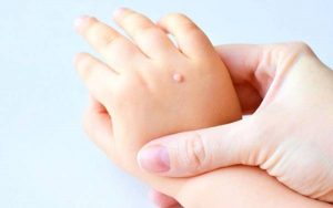 Common Baby Skin problems in infants