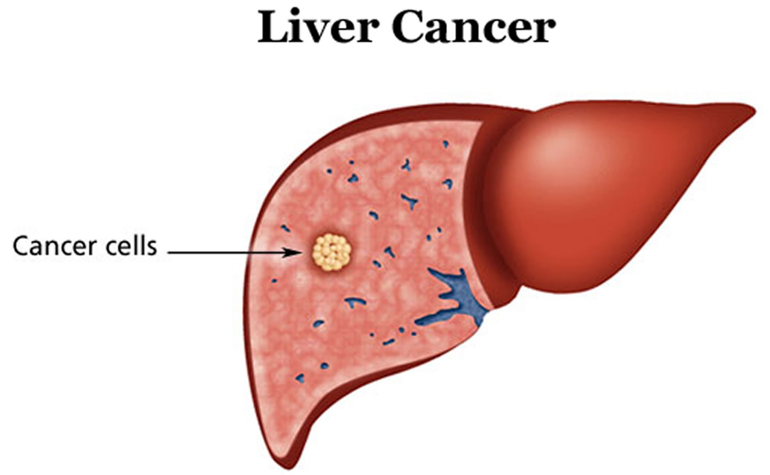 Symptoms and treatment of liver cancer