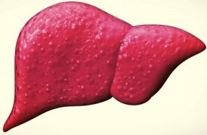 Symptoms and treatment of liver cancer