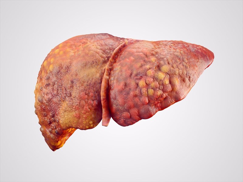 What is liver cirrhosis? How is it treated?