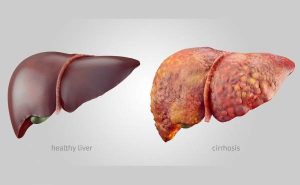 What is liver cirrhosis? How is it treated?