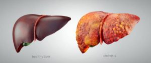 Everything about liver disease and its symptoms and types