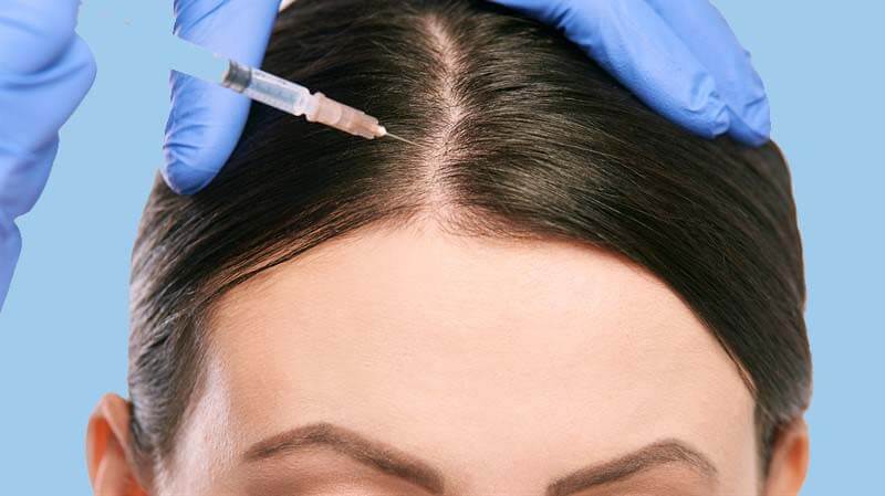 Treatment of hair loss with mesotherapy