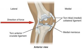 How Do You Treat A Torn Knee Ligament Without Surgery?