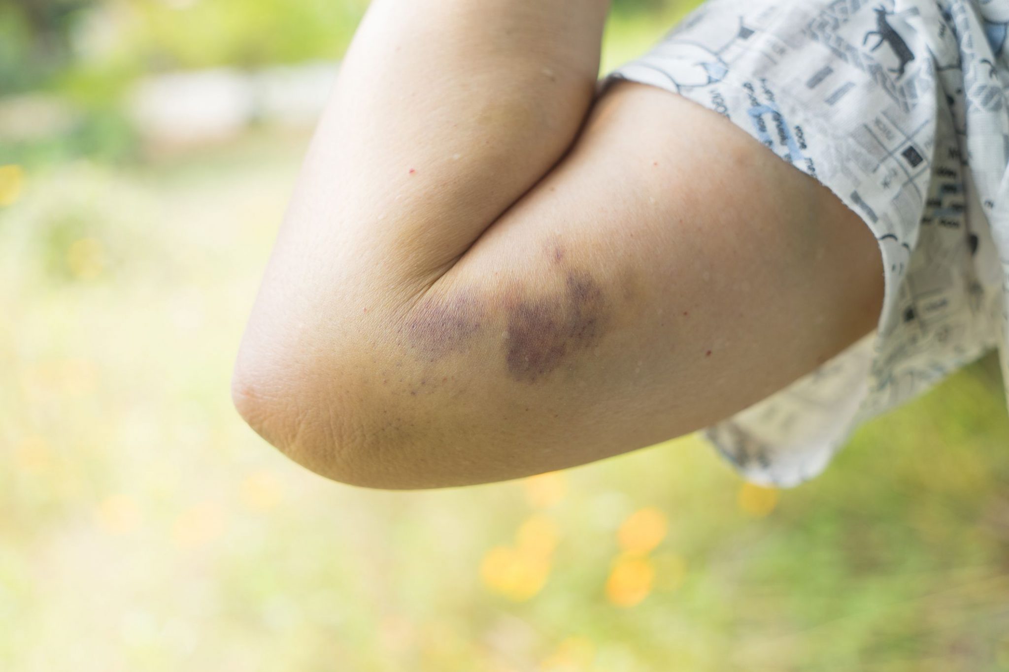 What Disease Causes Your Skin To Bruise