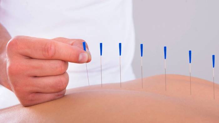 Acupuncture