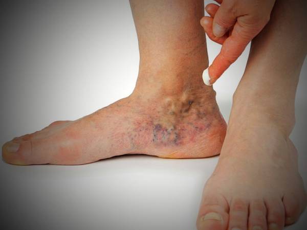 What causes blood clots in the legs?