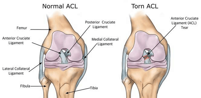 How Do You Treat A Torn Knee Ligament Without Surgery?