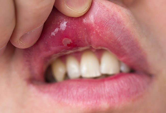 Cause, symptoms, and treatment of Aphthous stomatitis