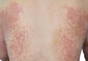 What is skin Hives? And how is it treated?