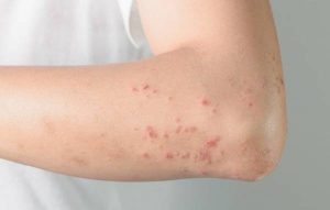What is skin Hives? And how is it treated?