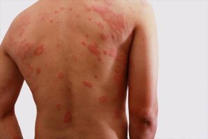 What is skin Hives? And how is it treated?