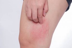 What is skin Hives? And how is it treated?