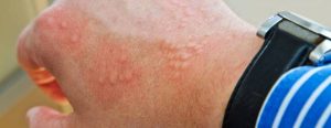 What is skin Hives? And how is it treated?