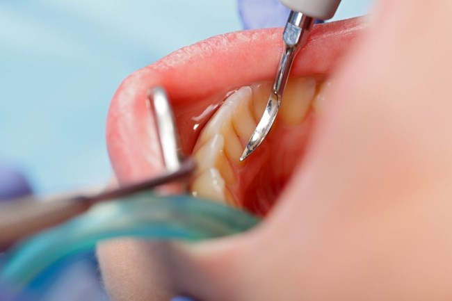 How to remove dental plaque
