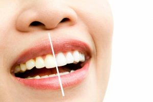 Everything about teeth scaling and its benefits and harms