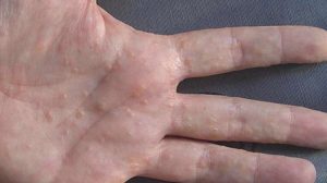 dyshidrotic eczema; Symptoms, prevention, and treatment