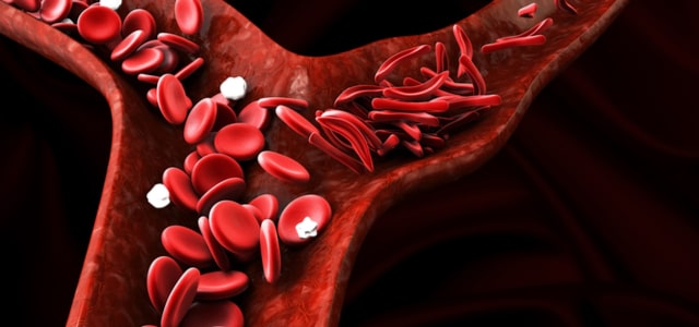 Signs and symptoms of iron deficiency anemia in the body