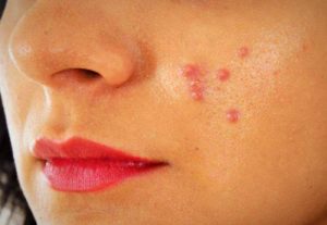 What do pimples indicate about the health of the body?