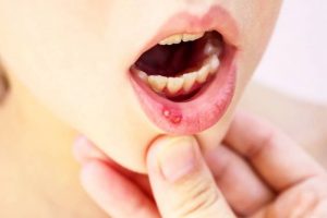 Cause, symptoms, and treatment of Aphthous stomatitis