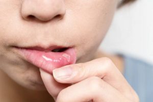 Cause, symptoms, and treatment of Aphthous stomatitis