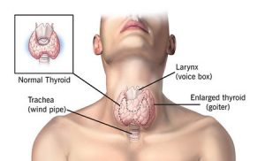 What is a goiter? Types and methods of treating goiter