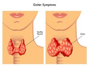 What is a goiter? Types and methods of treating goiter