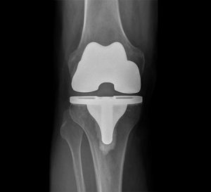 What is a Knee Replacement? Types of knee prosthesis