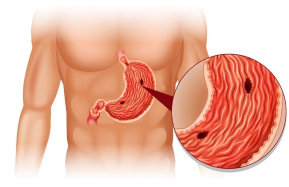 Peptic ulcer disease, its causes, and treatment