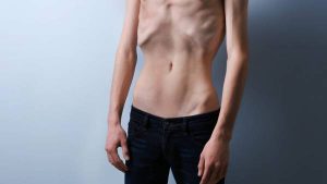 Answers to parents questions about anorexia in adolescents