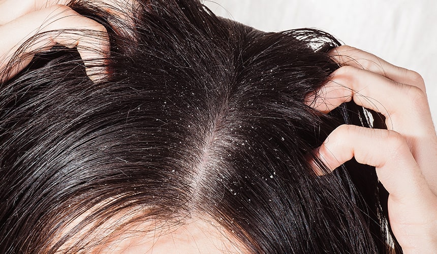 What is dandruff, and how is it caused?