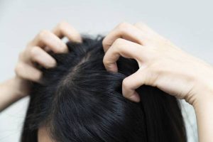 What is dandruff, and how is it caused?