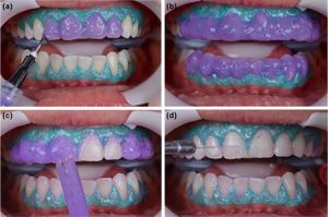 What is dental bleaching? Side effects and benefits