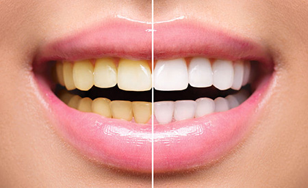 What is dental bleaching? Side effects and benefits