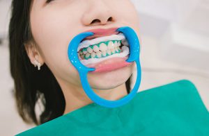 What is dental bleaching? Side effects and benefits