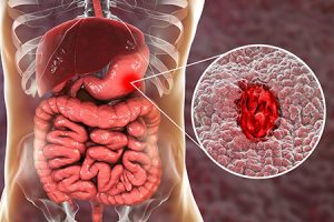 Peptic ulcer disease, its causes, and treatment