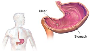 Peptic ulcer disease, its causes, and treatment