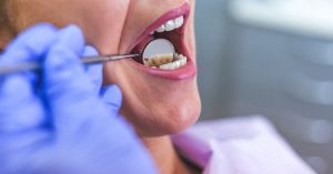 Causes, symptoms, and treatment of gingivitis