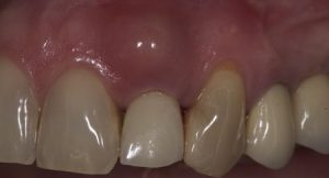 Causes, symptoms, and treatment of gingivitis