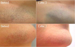 Important points before and after laser hair removal