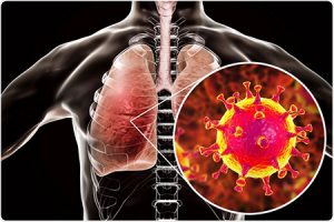 Causes, symptoms, and treatment of lung infection