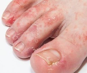 Answers to questions related to toenail loss