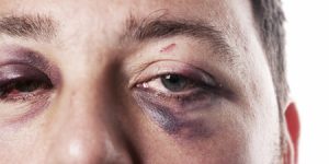 Treatment of bruising and black eye of the eye due to trauma