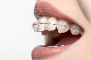 What is Orthodontics treatment?