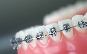 What is Orthodontics treatment?