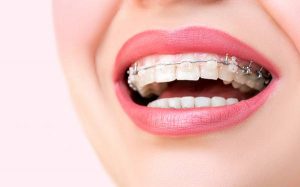 What is Orthodontics treatment?