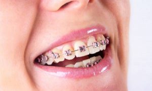 What is Orthodontics treatment?