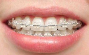 What is Orthodontics treatment?