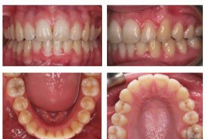 Stages of denervation and Dental Filling